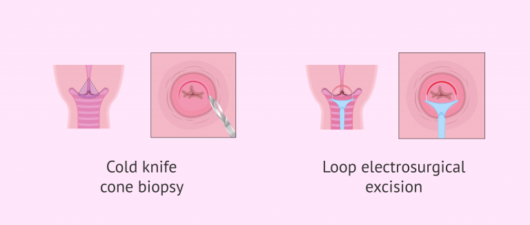 Conization Definition Cervical Conization: Types and Possible Complications