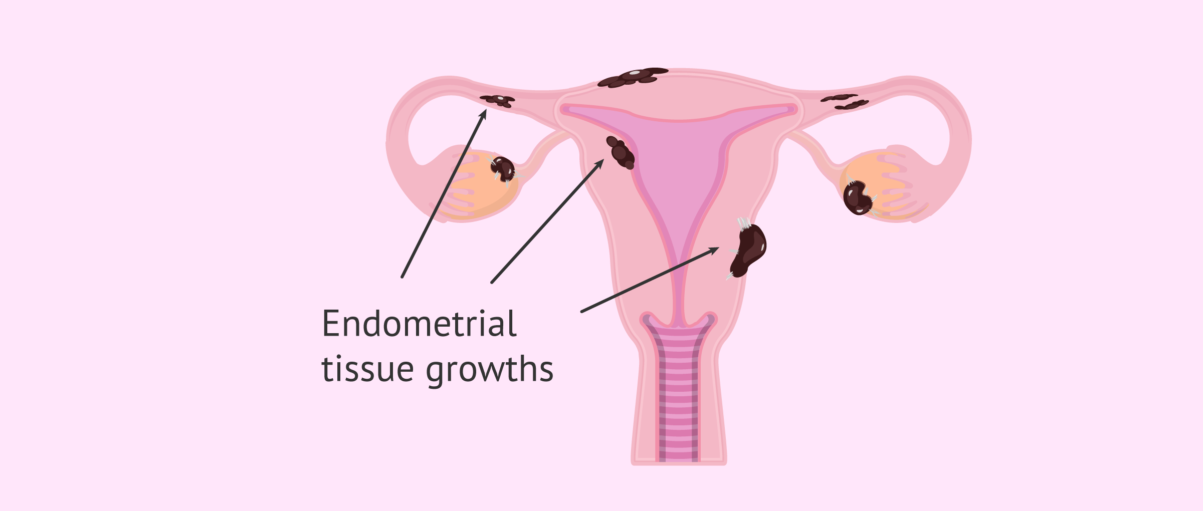 Areas of the female reproductive system with endometriosis