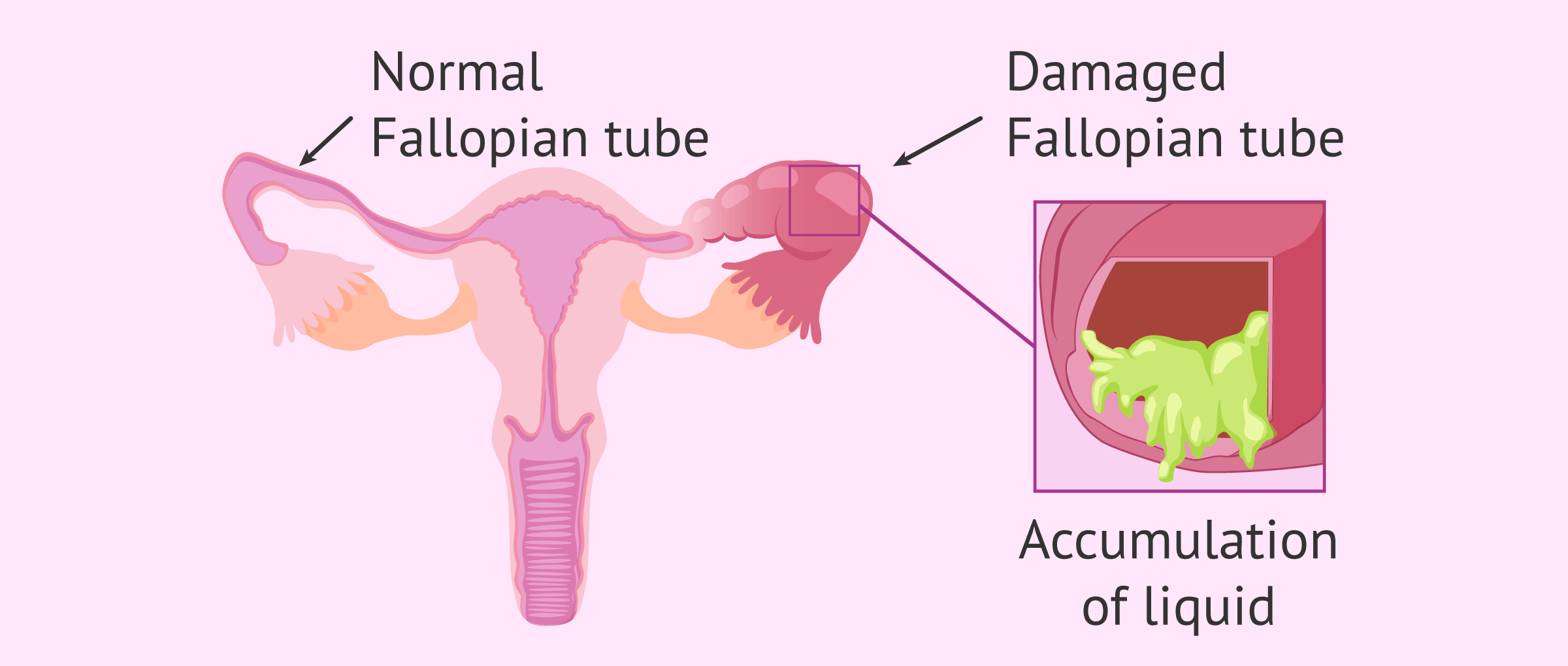 Normal Fallopian tube and Fallopian tube with hydrosalpinx