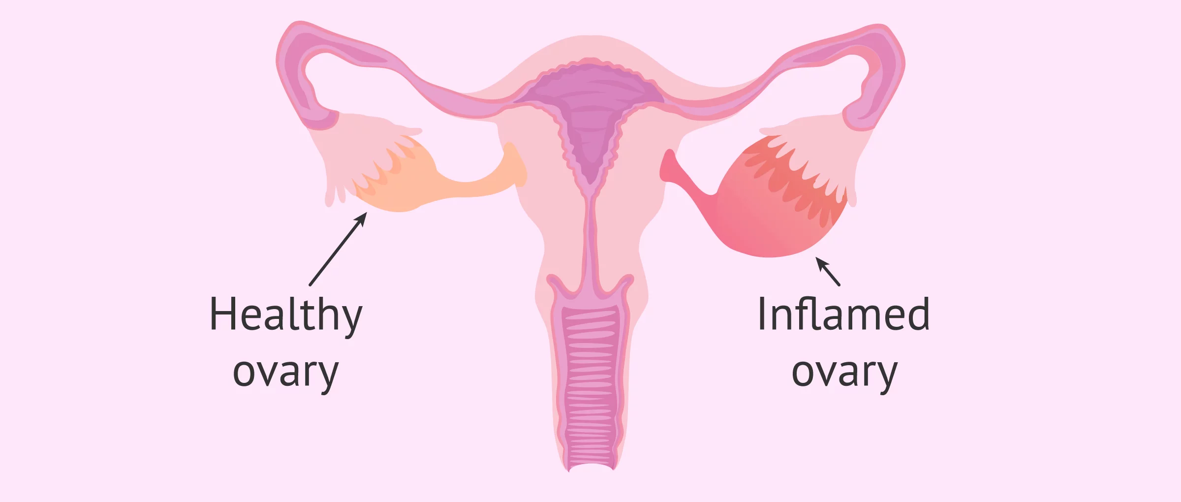 Imagen: Inflamed ovaries