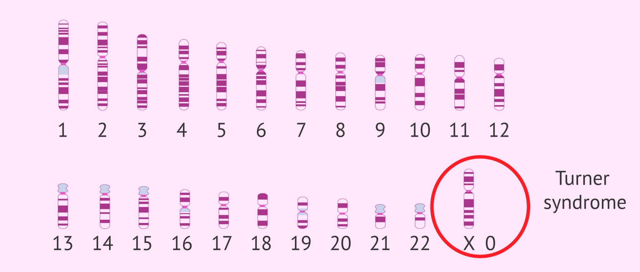 Turner Syndrome Karyotype Turner Syndrome Karyotype