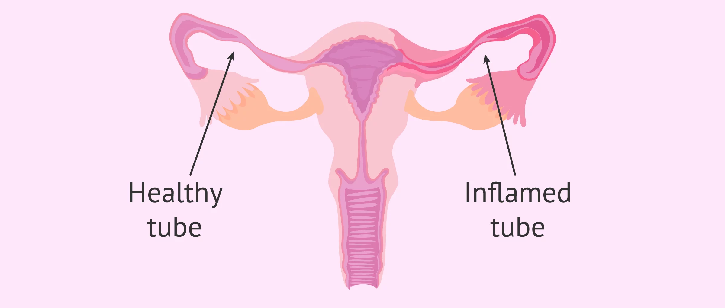 Imagen: Inflamed tube (Salpingitis)