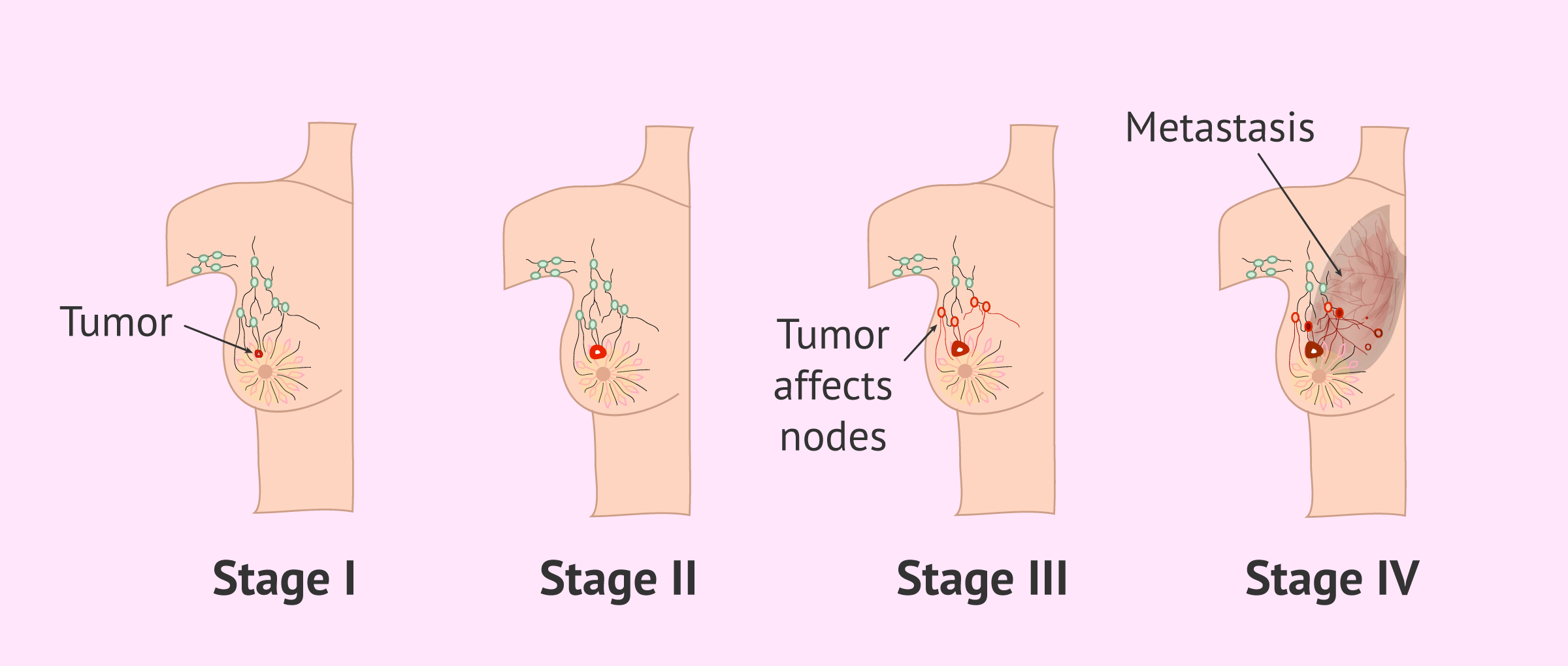 Stages of breast cancer