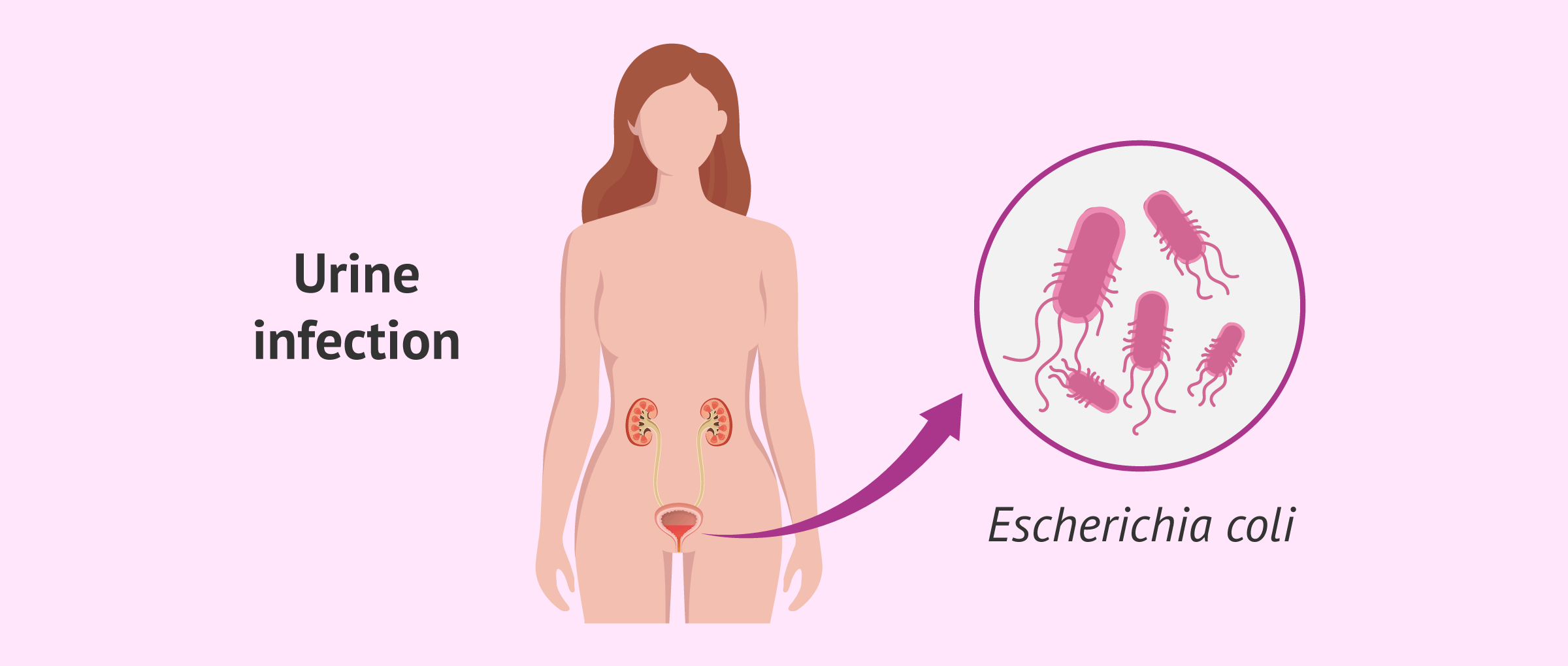 Infección de orina que hacer