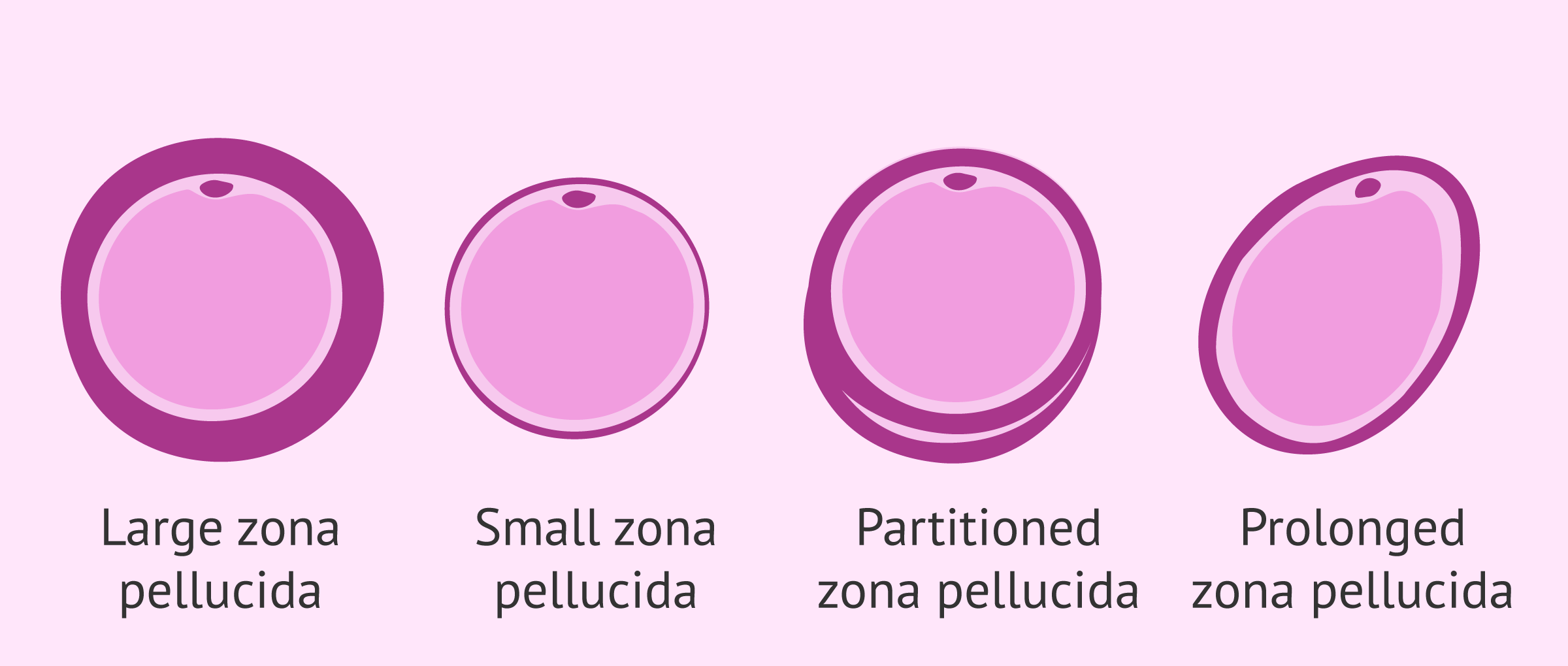 Alterations in the zona pellucida