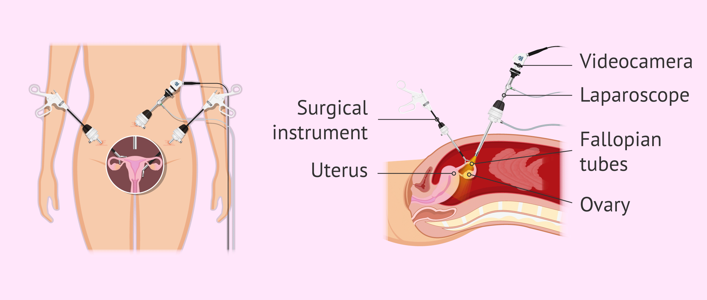 front-side view of a laparoscopy