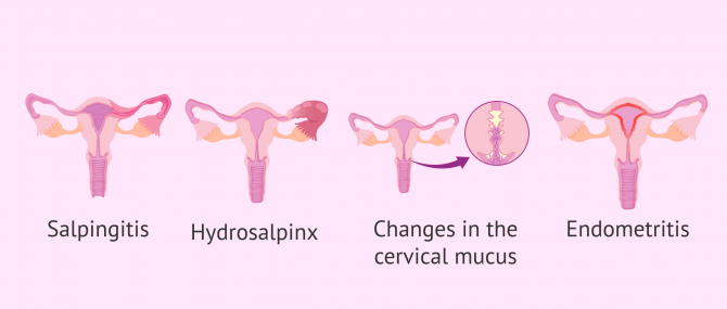 Imagen: Manifestations of STDs in female fertility