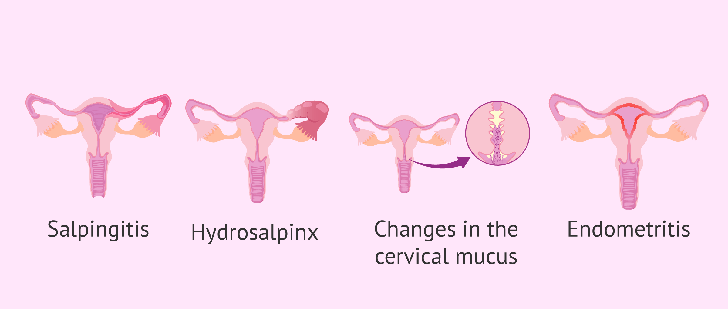Manifestations of STDs in female fertility