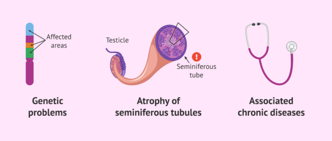 Imagen: Causes of irreversible oligospermia