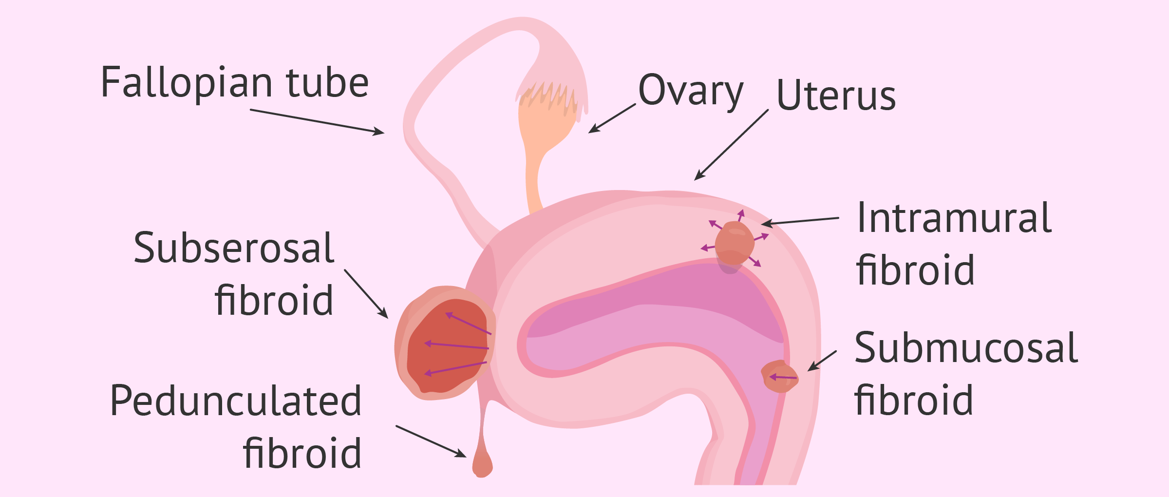 Localization of the different types of fibroids