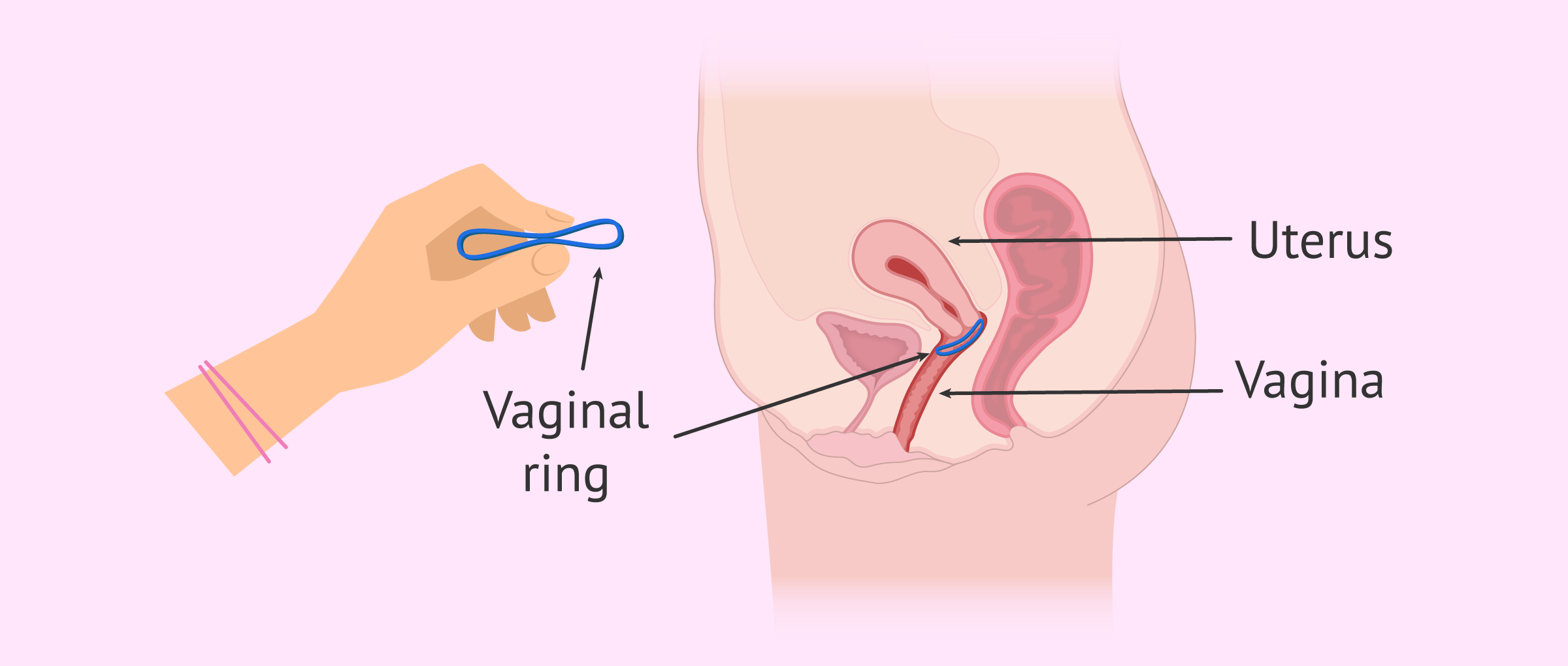 7 Signs an IUD Is Right for You—and 5 It Isn't | SELF