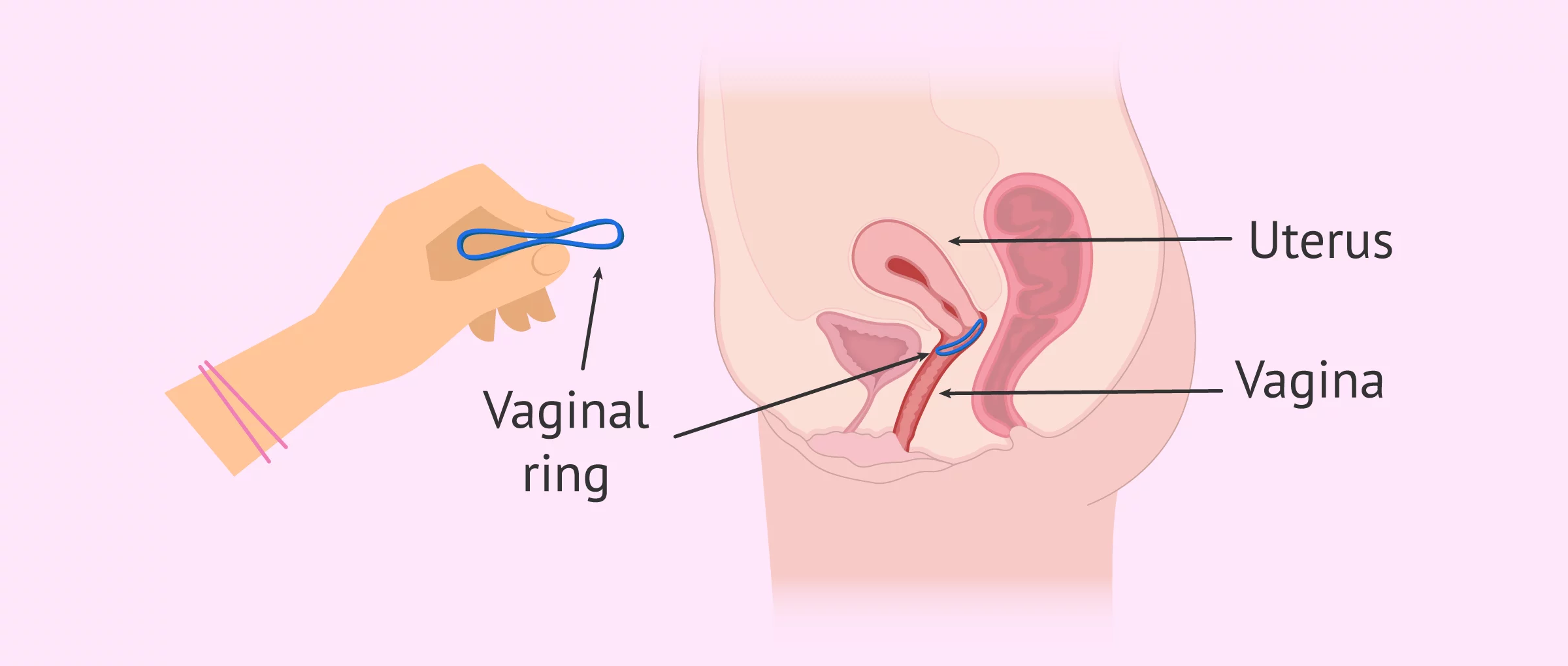 Vaginal ring as means of contraception