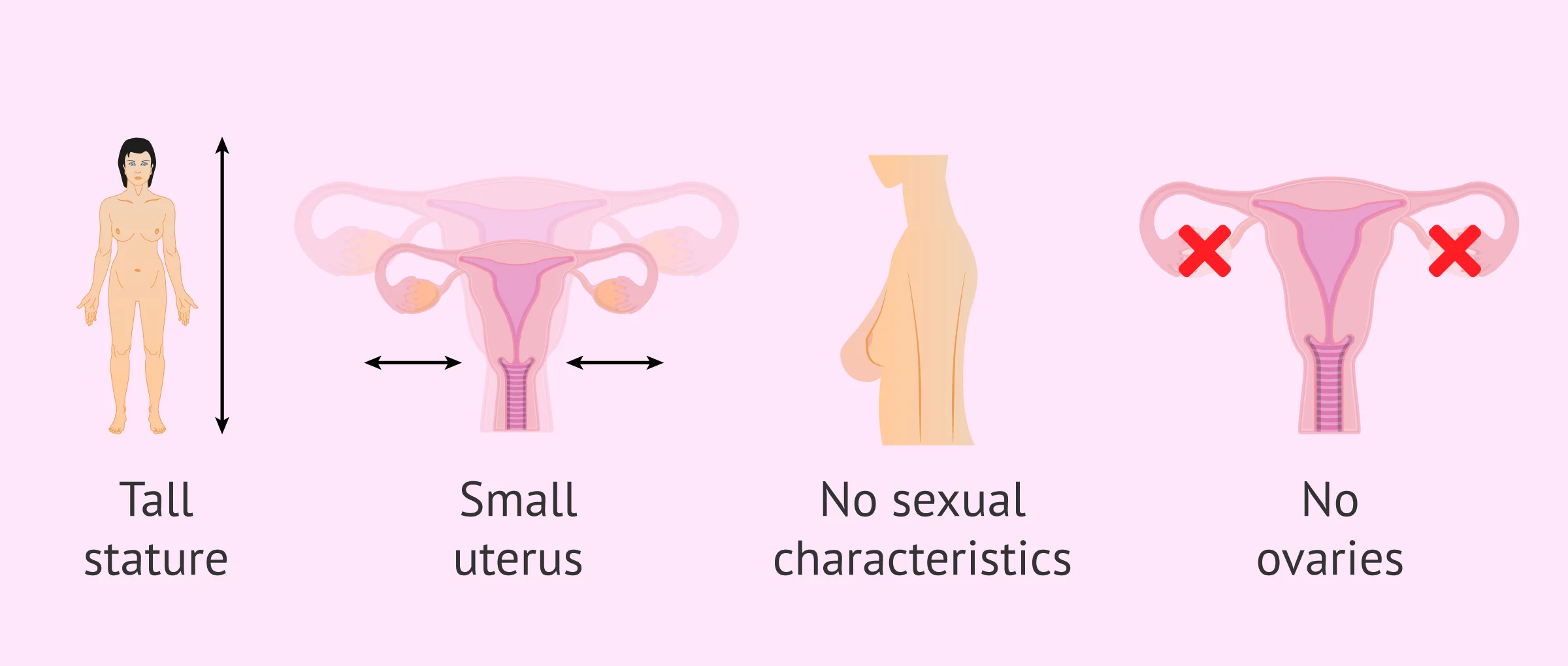 Imagen: Clinical manifestation of Swyer syndrome