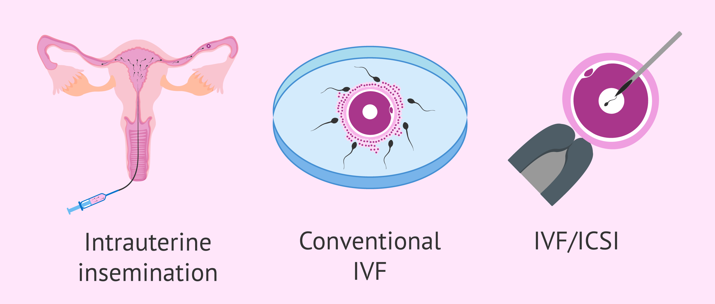 Assisted reproduction techniques