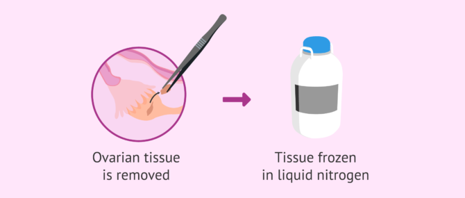Imagen: Method to cryopreserve ovarian tissue