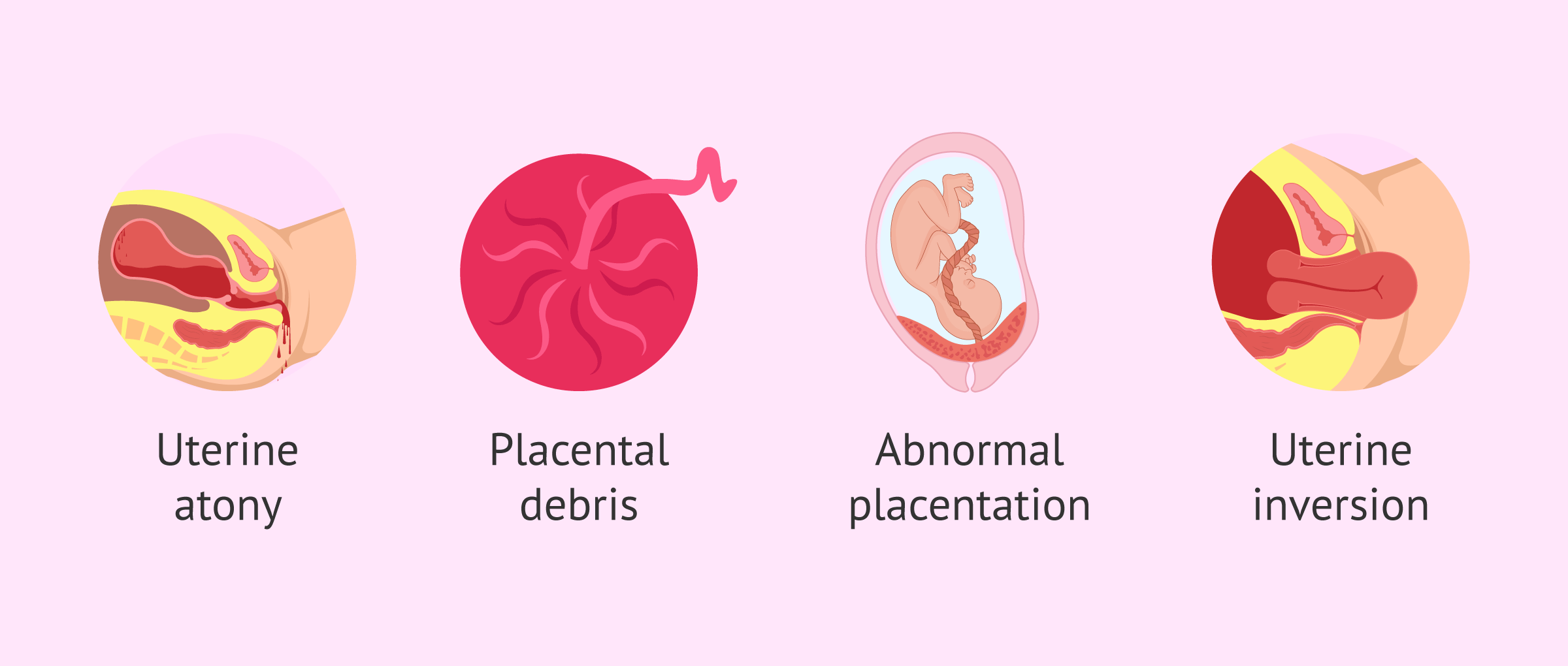 Causes of post-partum haemorrhage