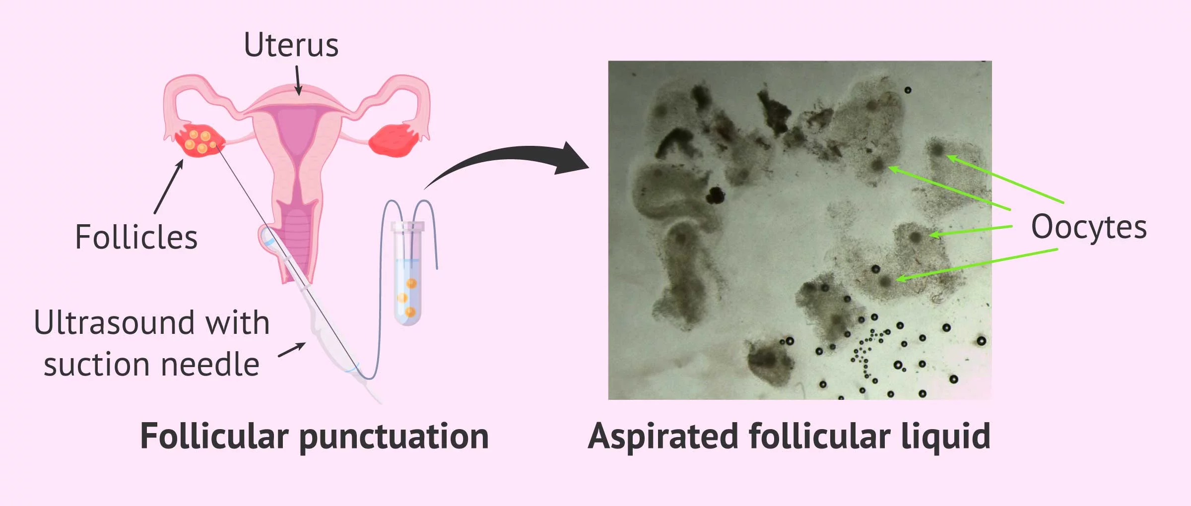 Imagen: Puncture and retrieval of follicular fluid
