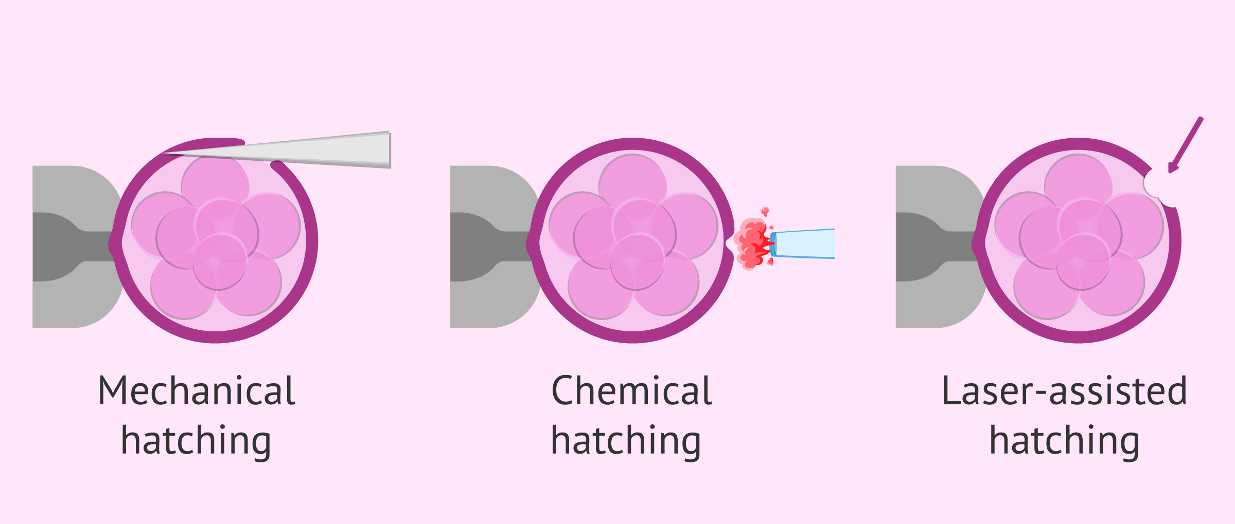 Numerisk syndrom Normalisering What Does Assisted Hatching (AHA) Mean in IVF?