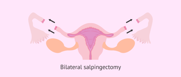 salpingectomy-how-and-why-are-the-fallopian-tubes-extracted