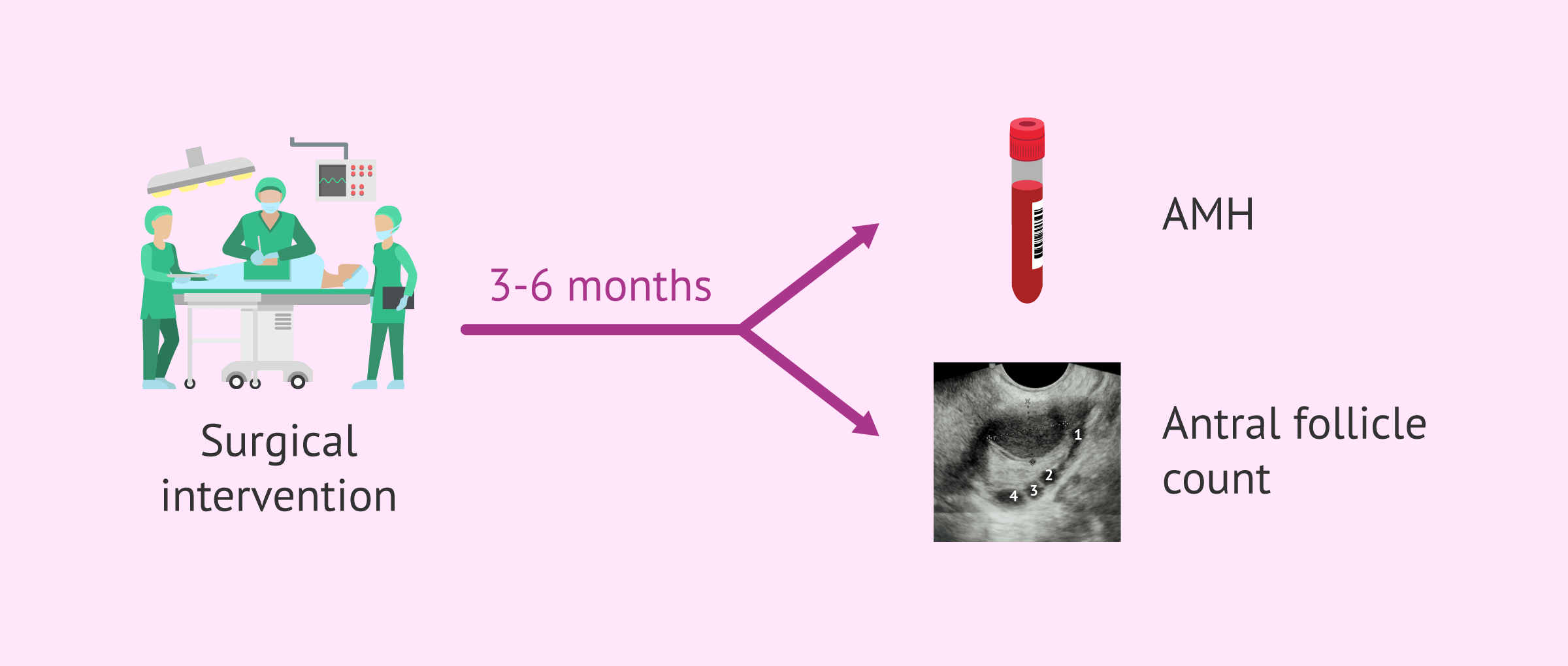 Imagen: Ovarian reserve after endometriosis surgery