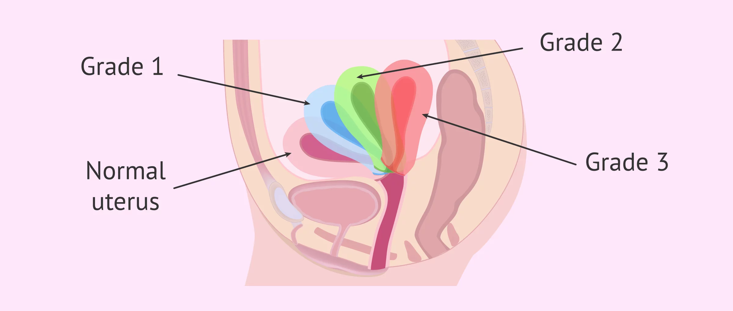Uterus Tipped Backwards Causes and Symptomes of Retroverted Uterus