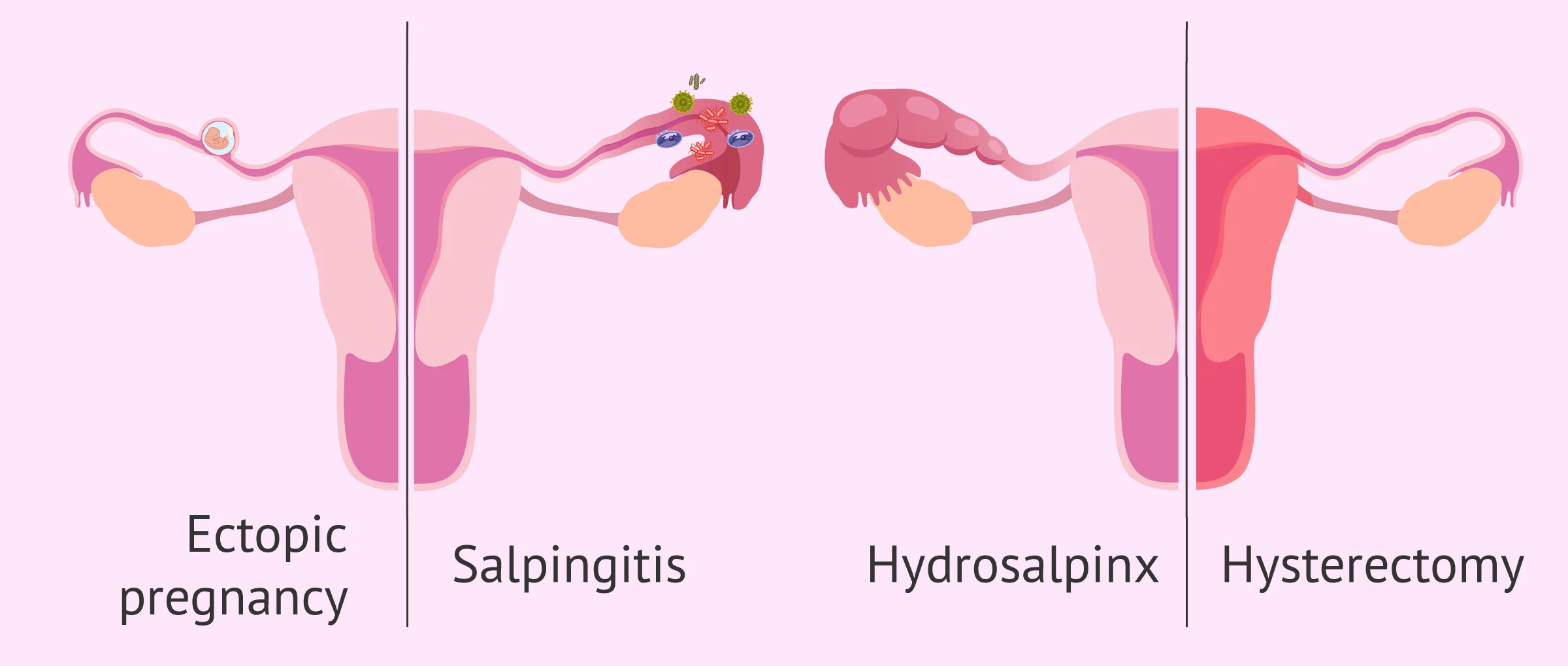 Salpingectomy: how and why are the Fallopian tubes extracted?