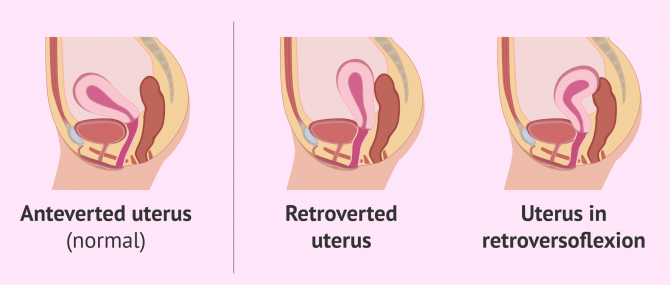 Uterus Tipped Backwards: Causes & Symptomes of Retroverted Uterus