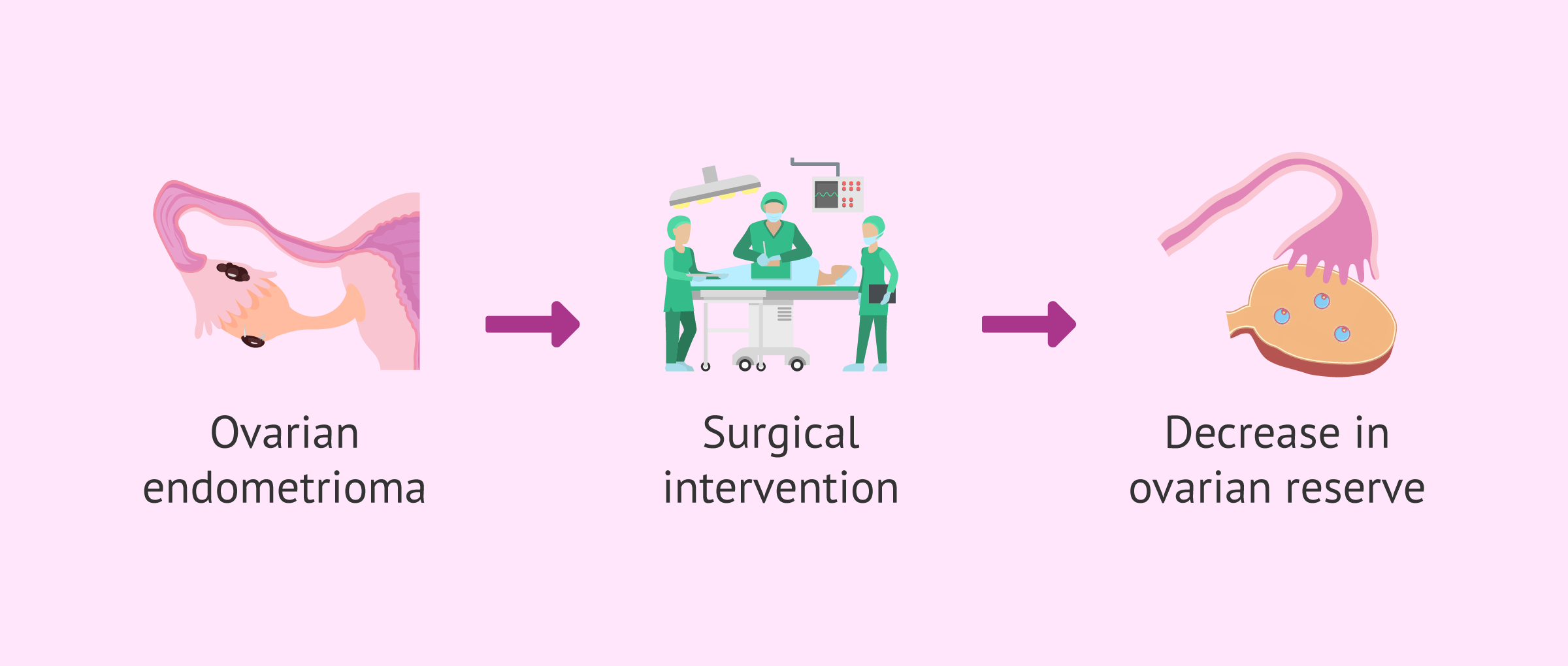 Endometrioma surgery: techniques that protect ovarian reserve