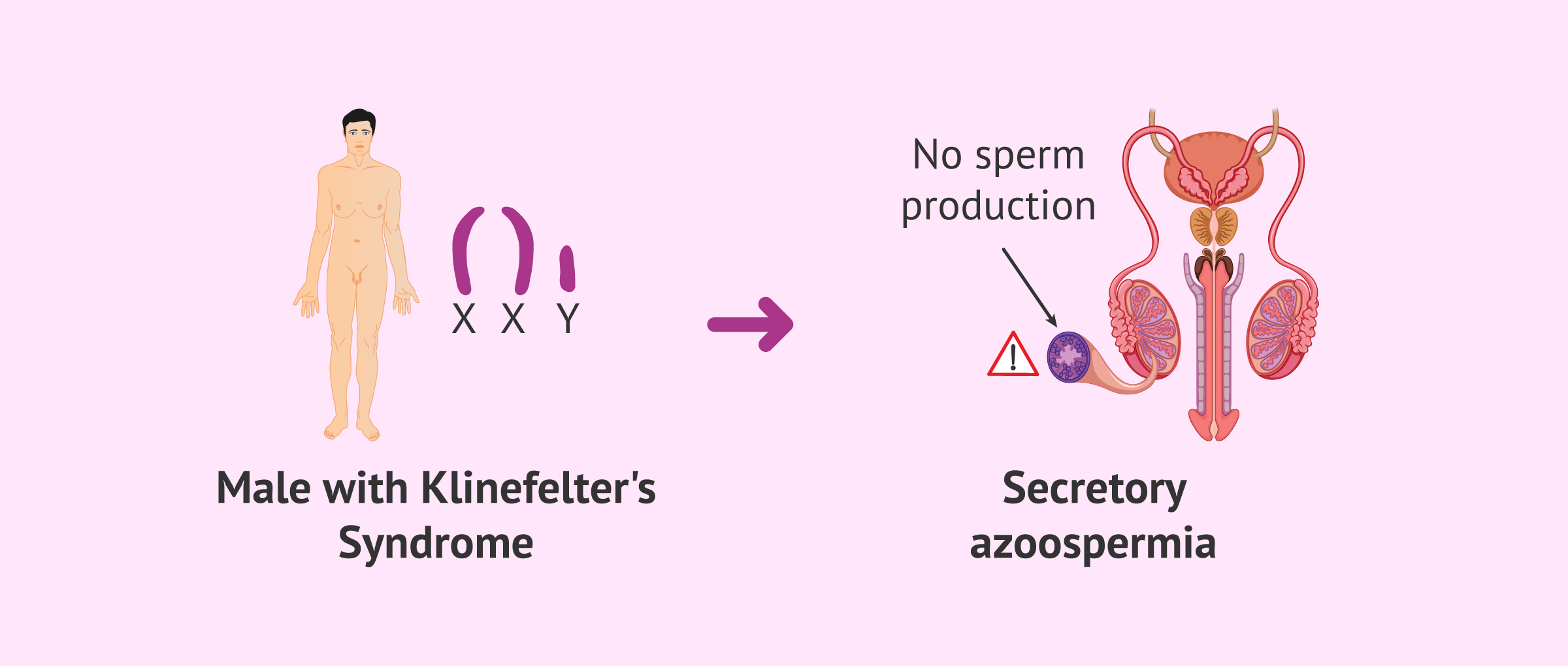Imagen: Secretory azoospermia in males with Klinefelter's syndrome