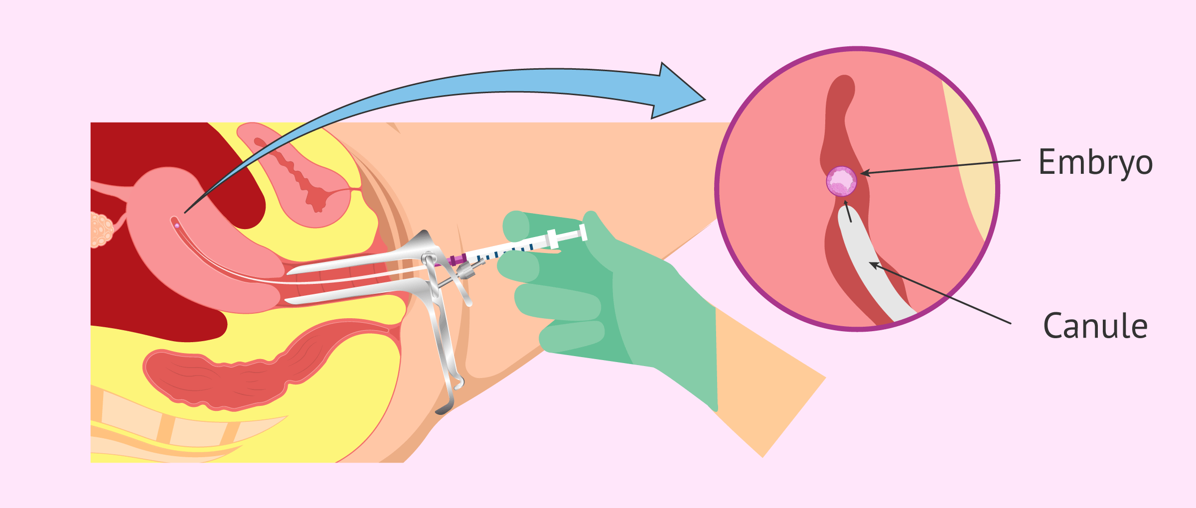 The embryo transfer phase