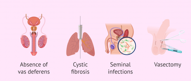Imagen: When is testicular biopsy performed?