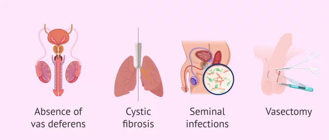 Imagen: When is testicular biopsy performed?