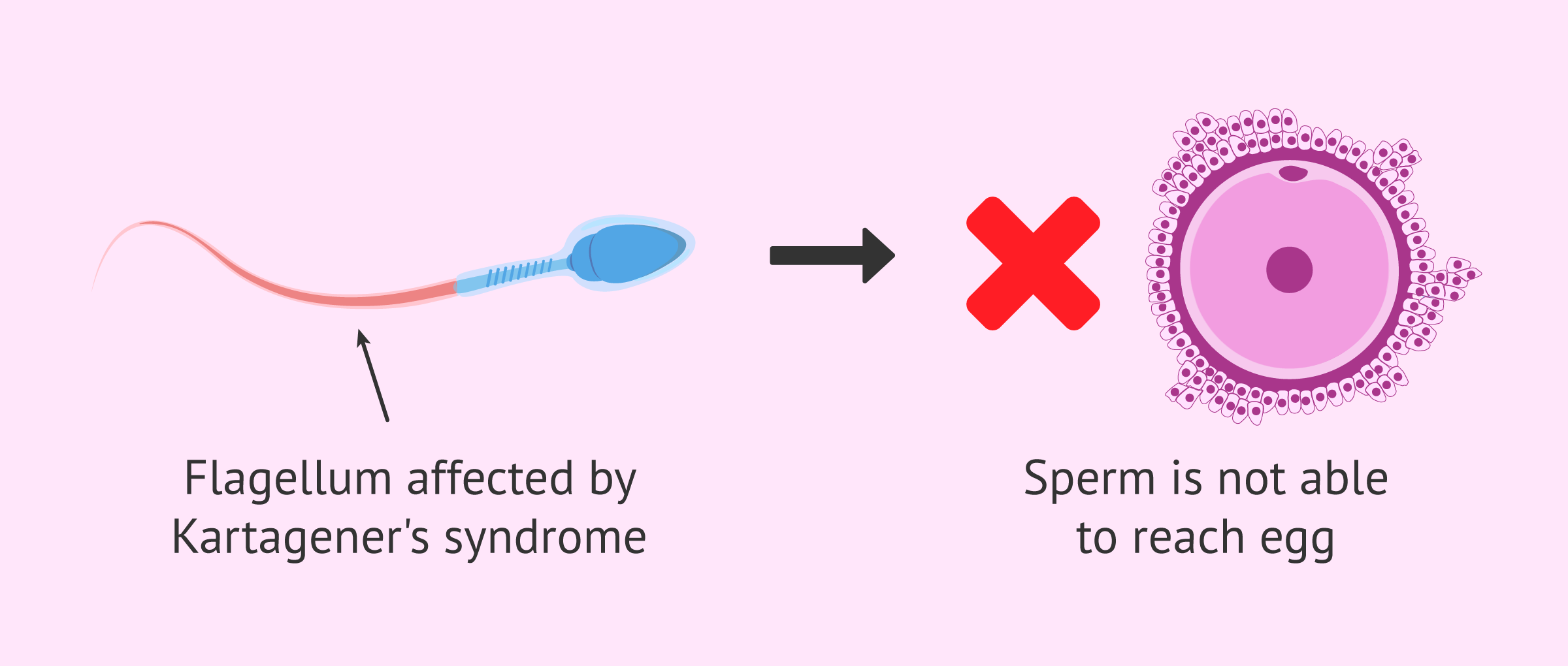 Male Infertility due to Kartagener's Syndrome