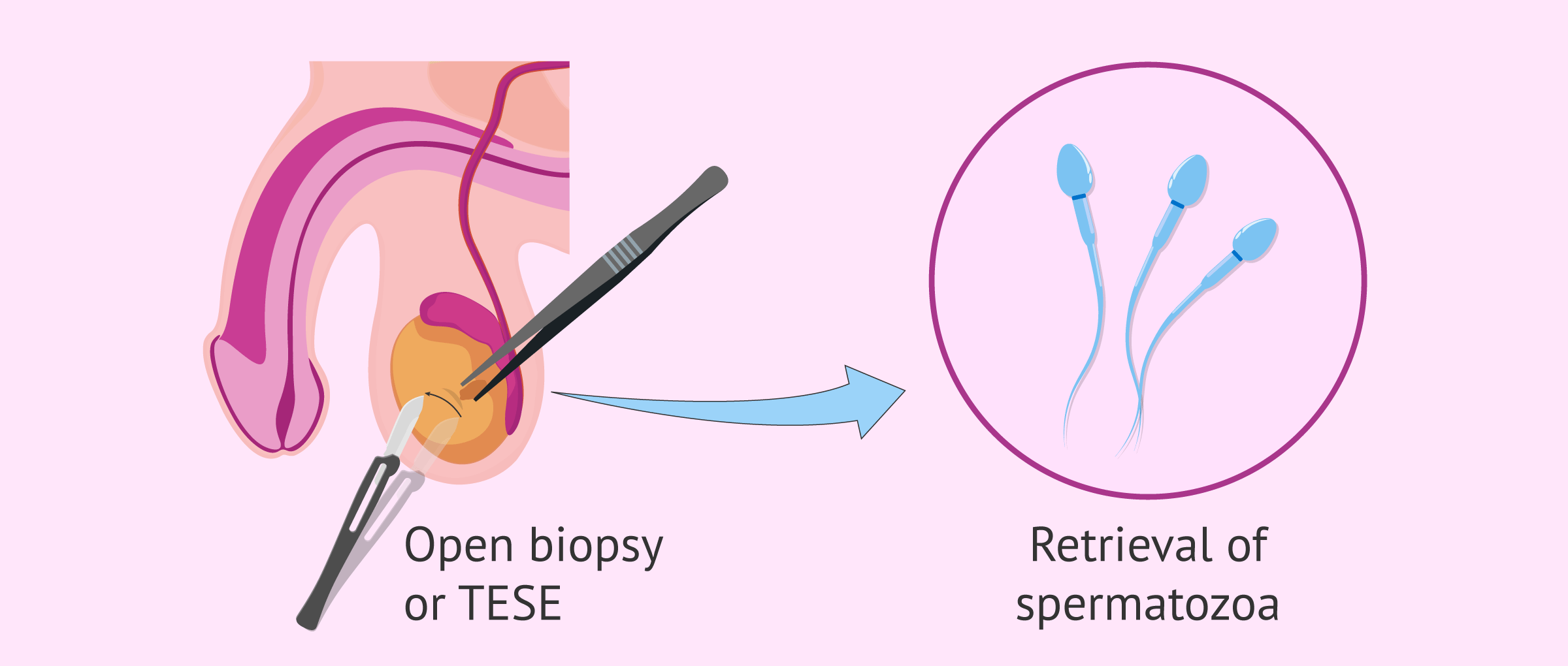 Open testicular biopsy (TESE)