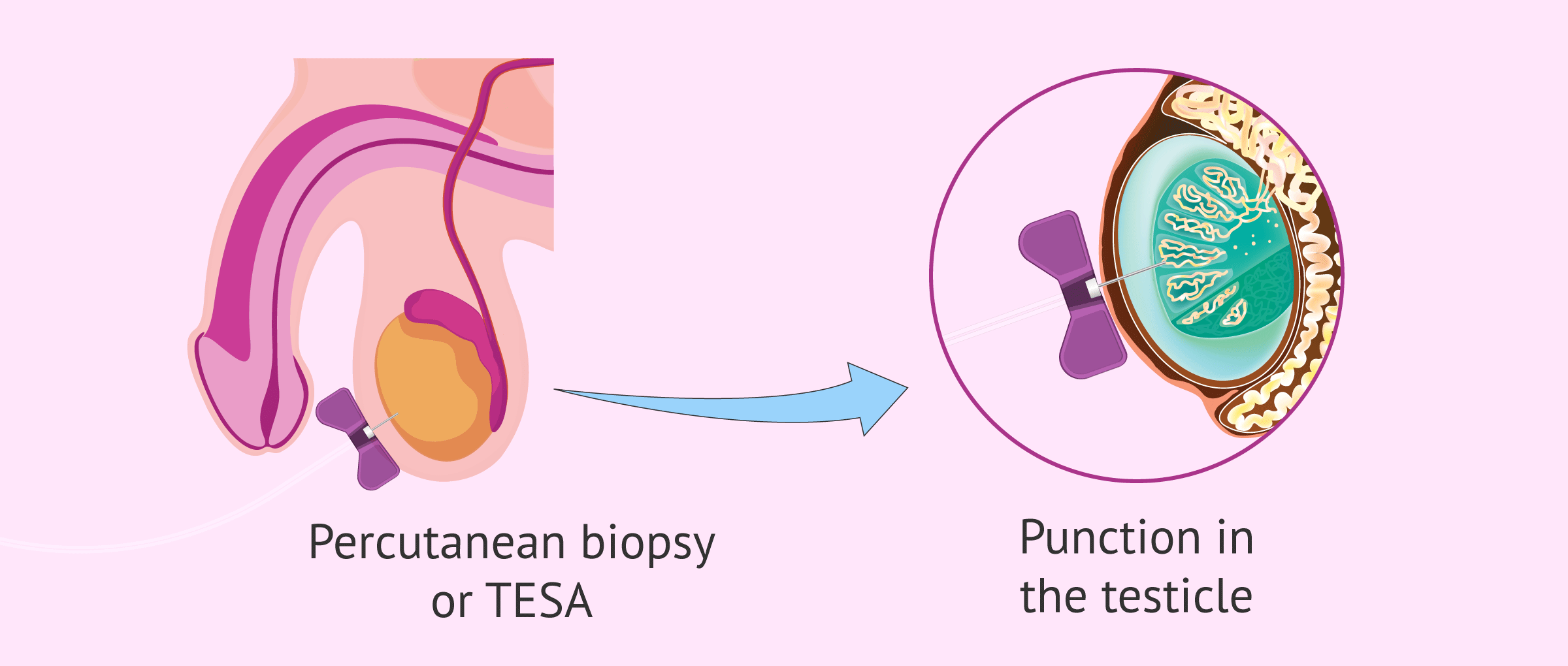Percutaneous Testicular Biopsy (TESA)