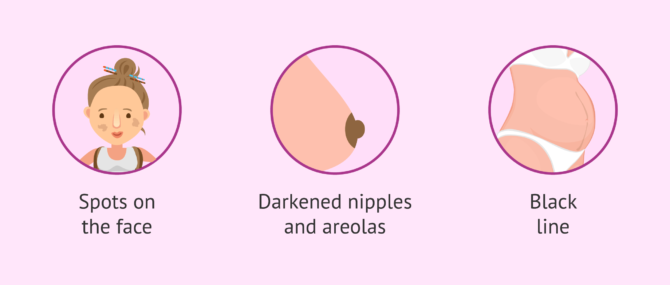 Imagen: Skin spots in pregnancy