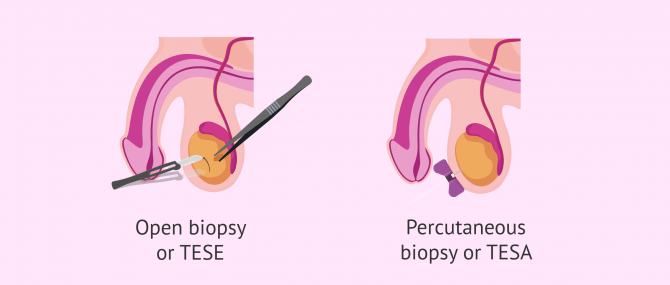 Imagen: Methods of performing testicular biopsy