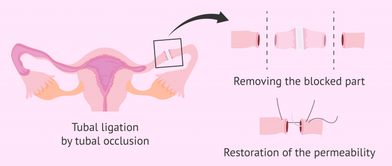 Reversal Of Tubal Ligation By Occlusion