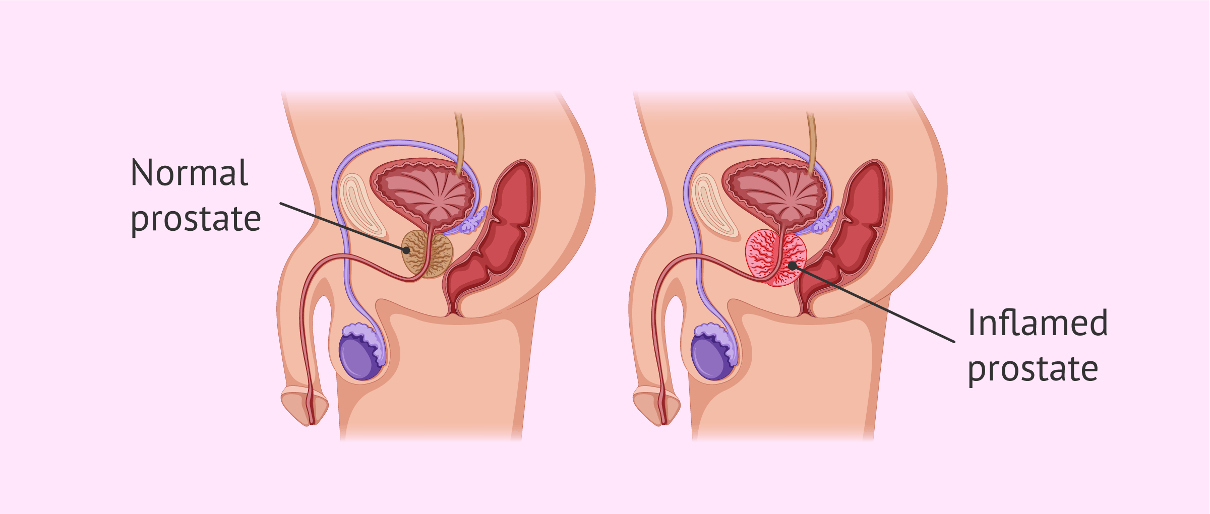 Prostatitis és ciszták vele Herék ciszta prosztatagyulladásból