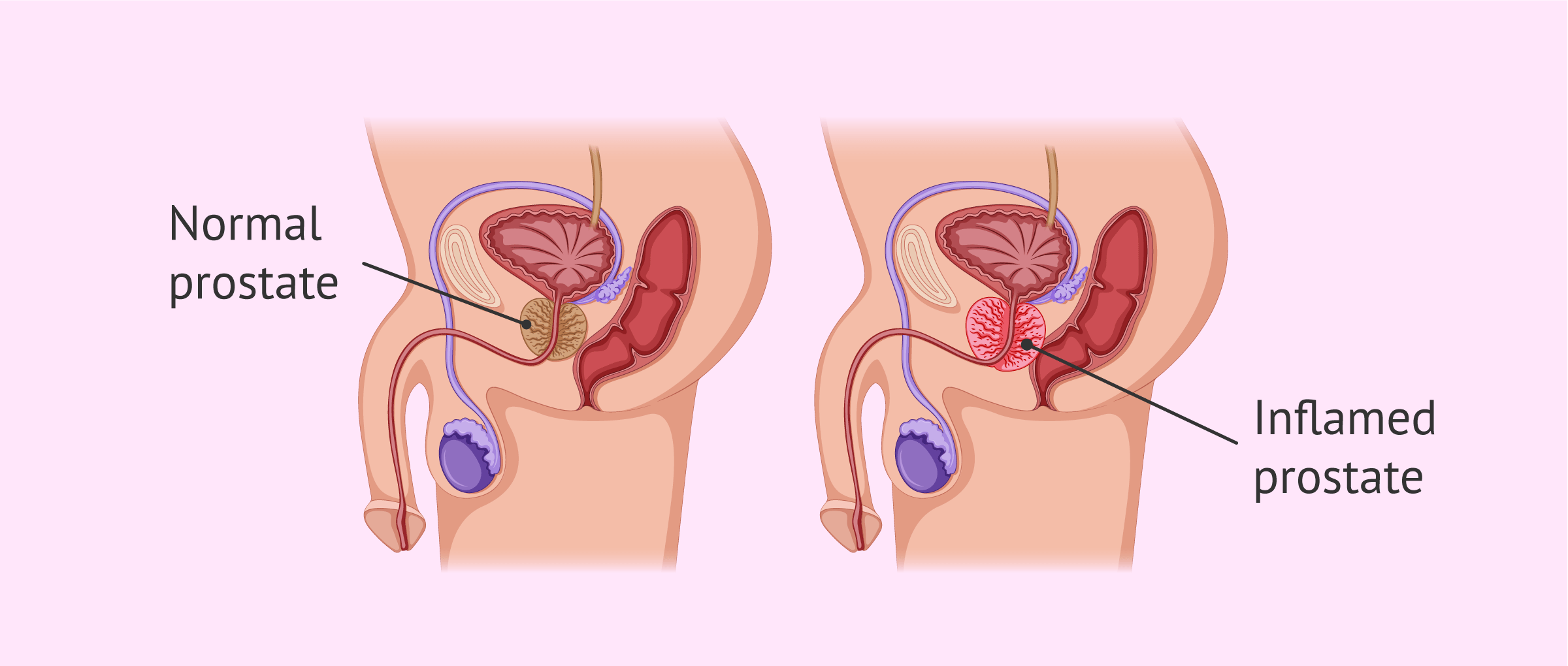 prostatitis support forum)