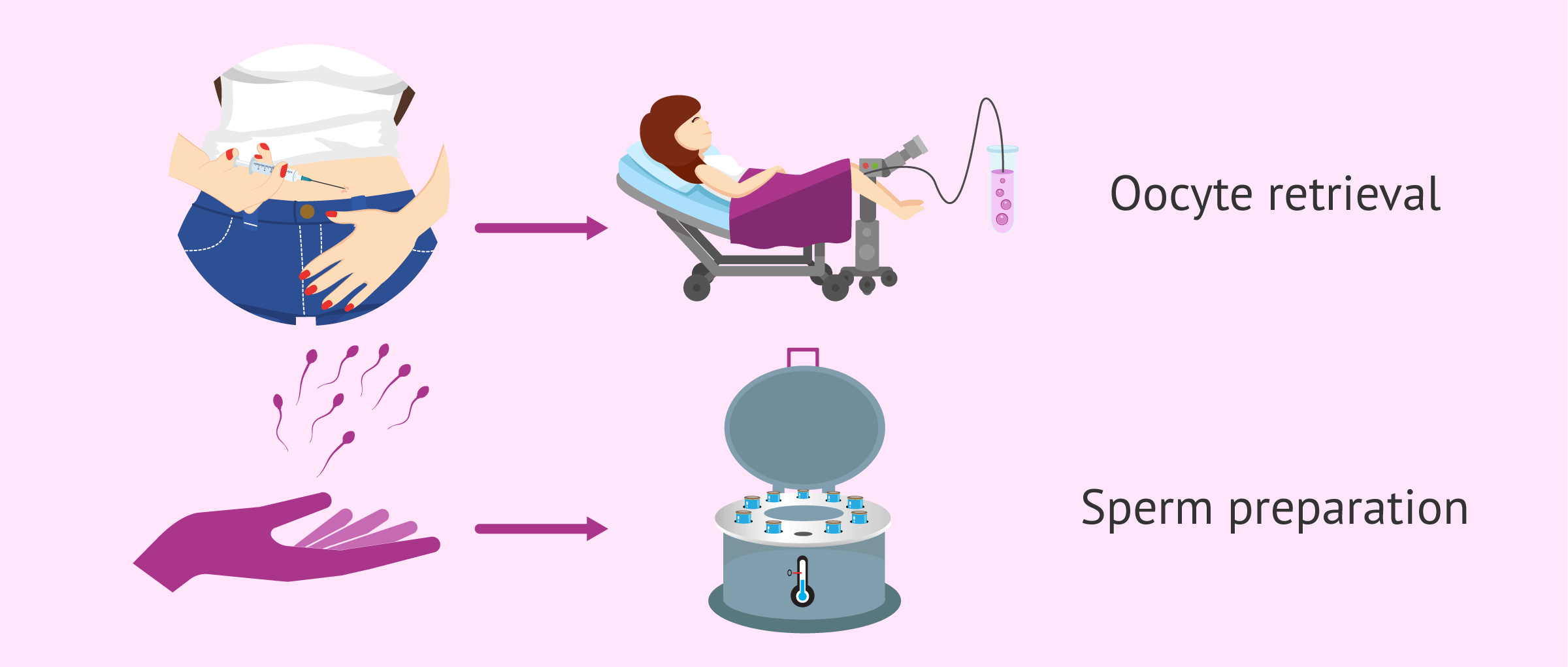 Process of IVF with donor sperm