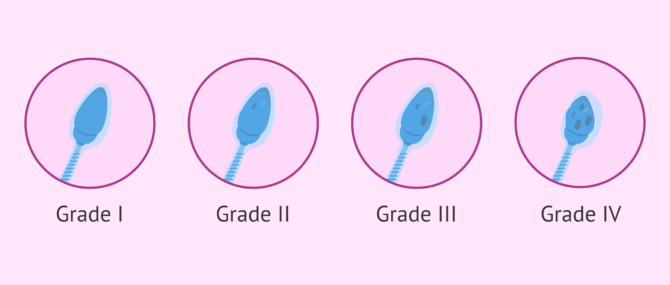 Imagen: Classification of spermatozoa with vacuoles