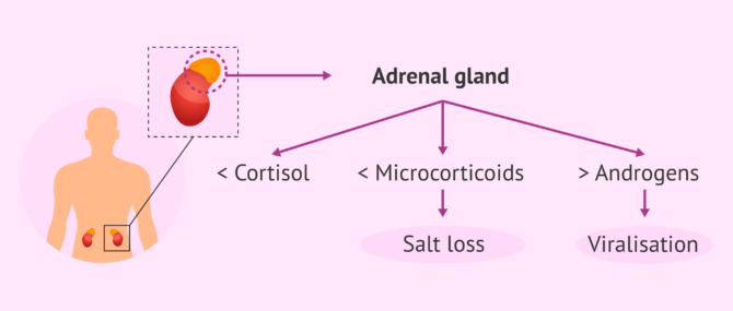 Imagen: Pathophysiology of congenital adrenal hyperplasia