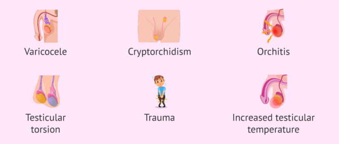 Imagen: What testicular factors can cause azoospermia?