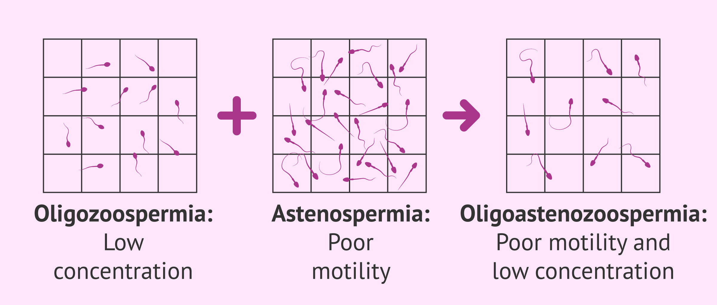 Sperm alteration oligoasthenozoospermia