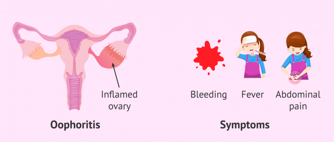 Oophoritis: Symptoms, Causes, and More