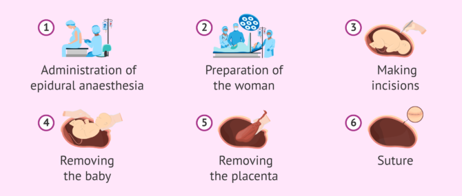 Imagen: Step by step of a planned caesarean section