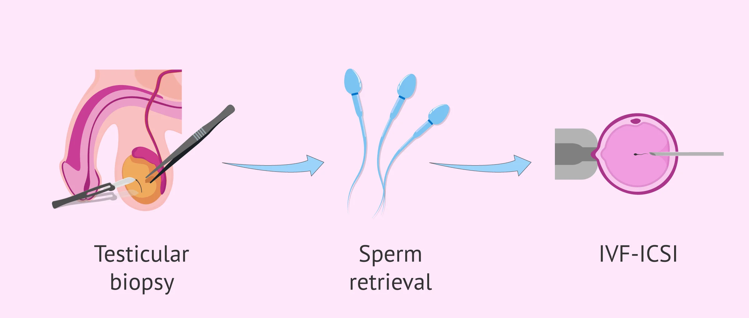 Imagen: treatment-anejaculation