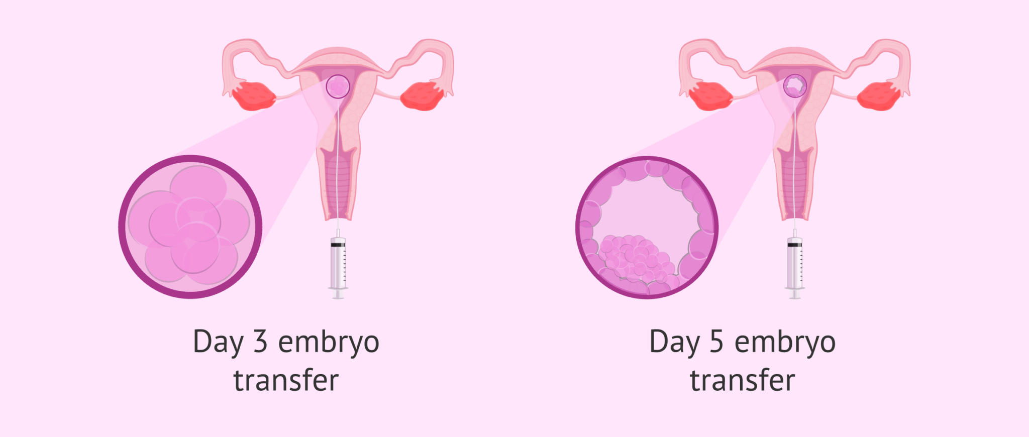 Embryo transfer when and how is it done?