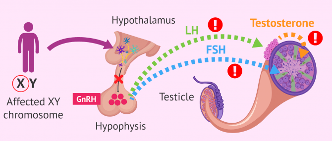 Imagen: What causes Kallman's Syndrome?